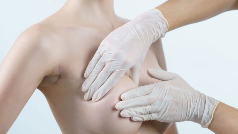 Mastopexia: Todo lo que necesitás saber