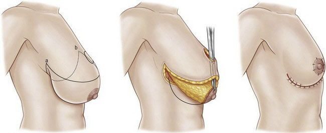 Mastopexia con autoprótesis: Descubrí el secreto para unos senos perfectos.