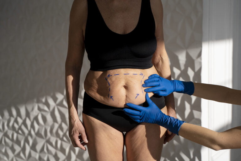 Beneficios y riesgos de la abdominoplastia: lo que debés tener en cuenta.