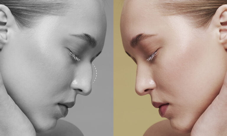 Rinoplastia: ¿cuánto tiempo dura el proceso de recuperación?