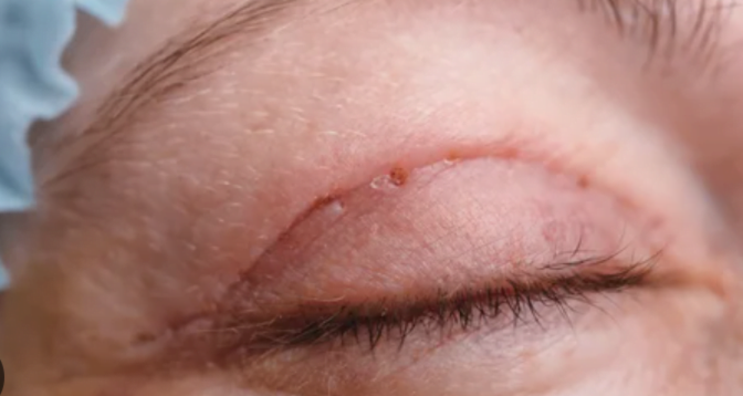 cirugia-parpados-cicatriz-blefaroplastia