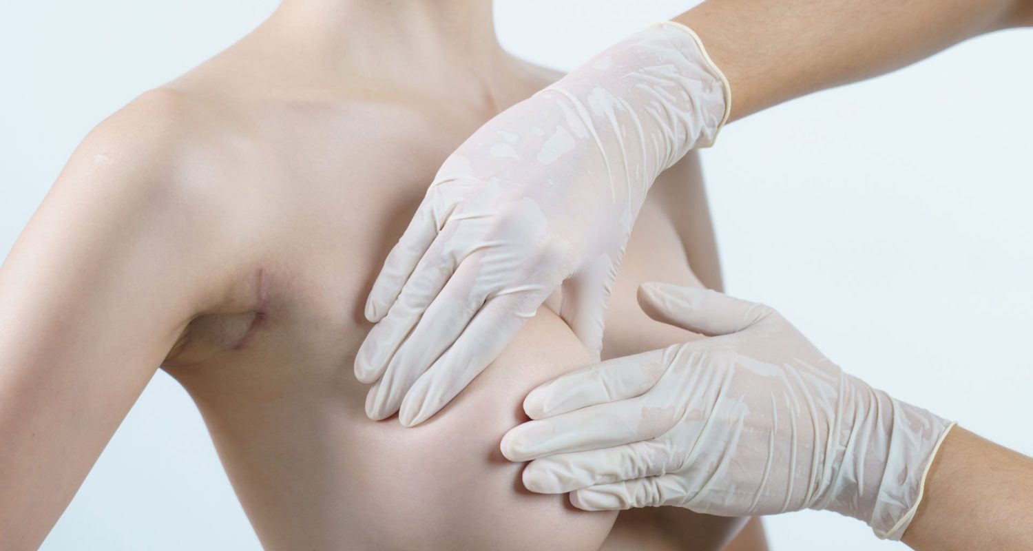 Mastopexia-con-y-sin-Protesis-en-buenos-aires