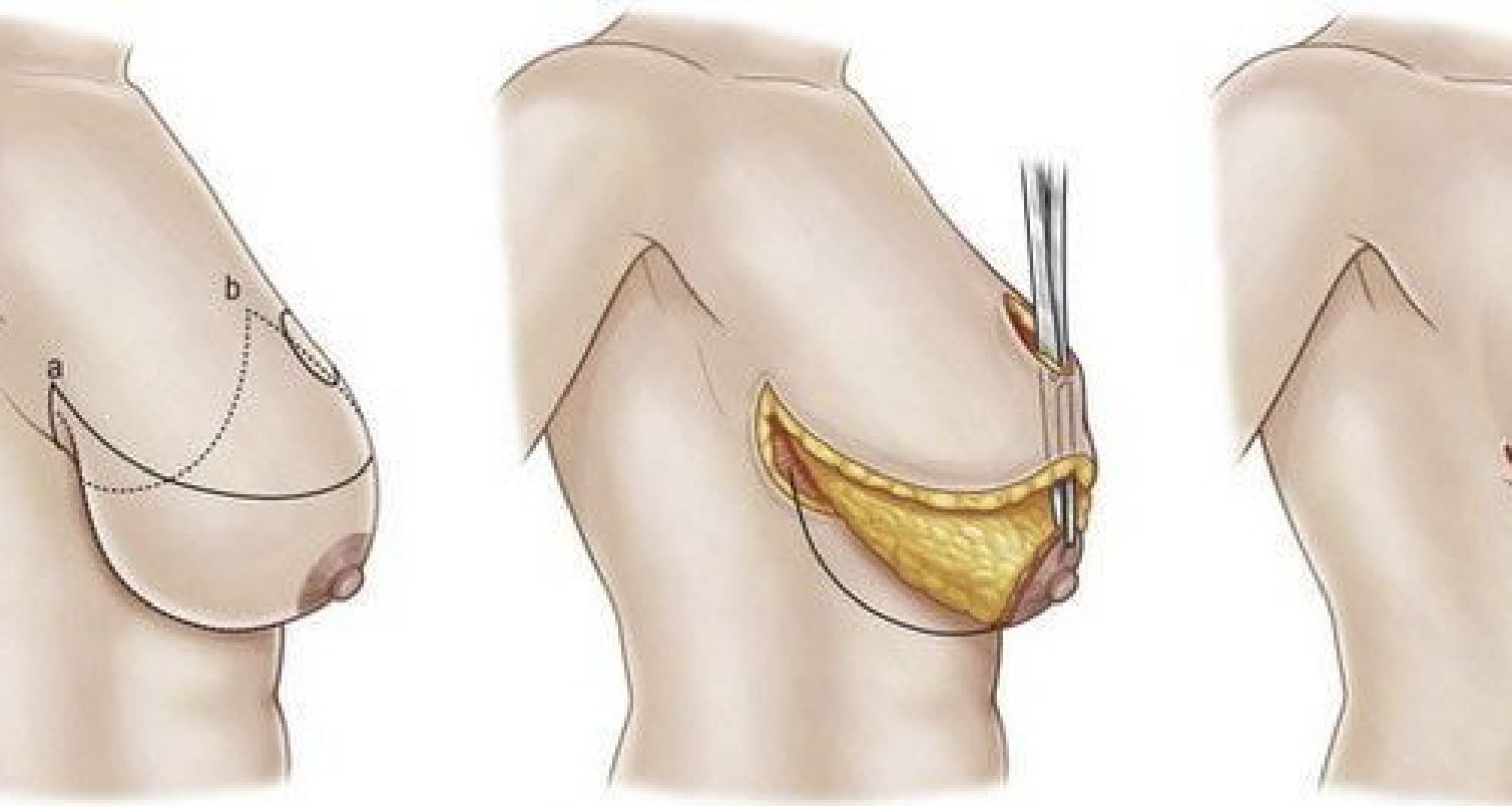 grafico_mastopexia-con-autoprotesis-sin-implantes