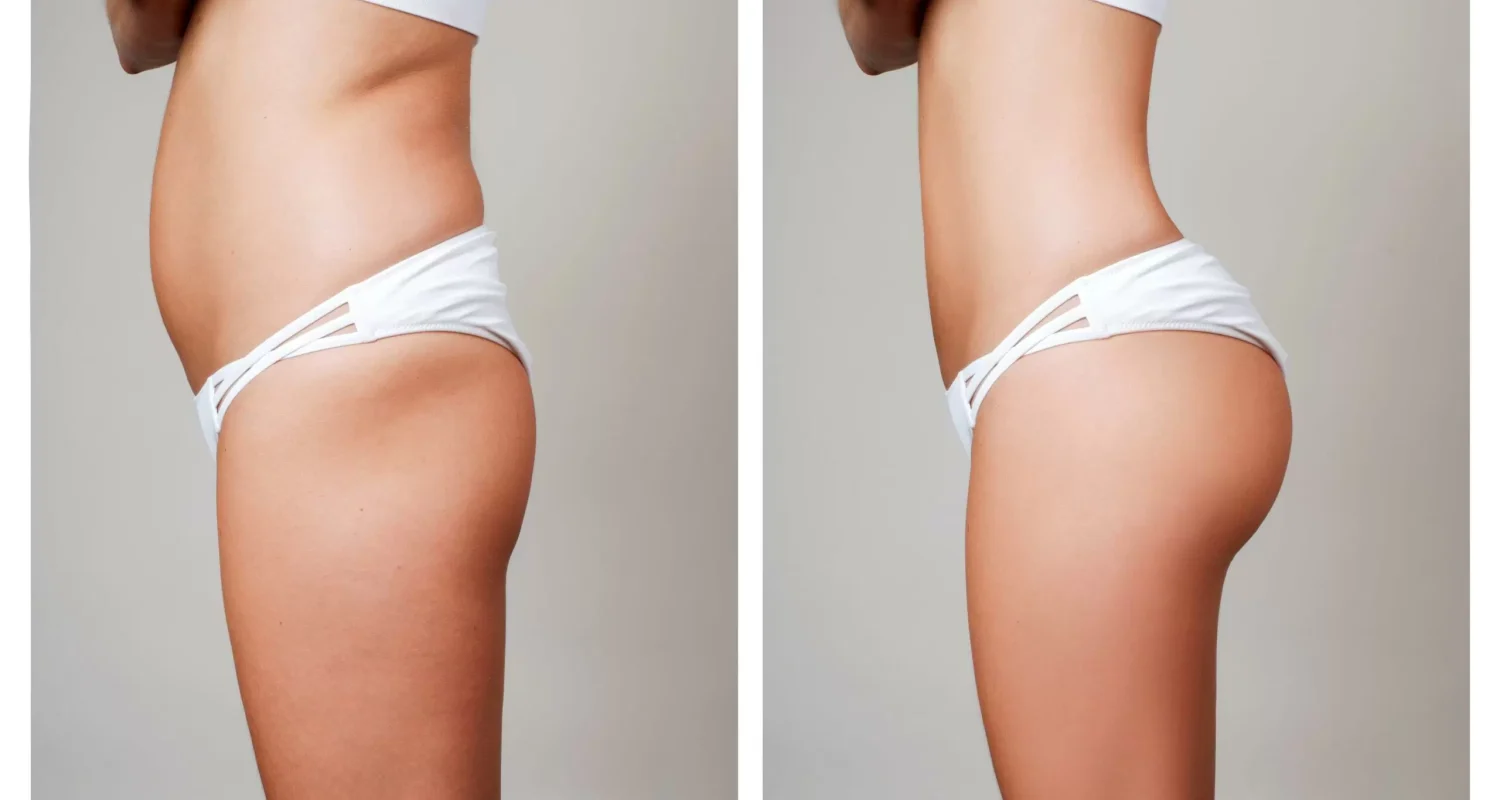 lipotransferencia-glutea-beneficios