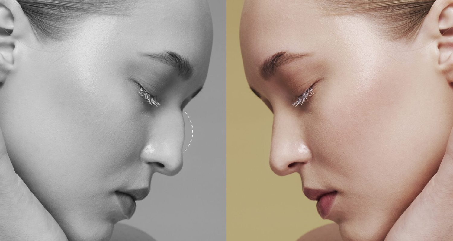 vista-lateral-mujer-joven-antes-despues-rinoplastia